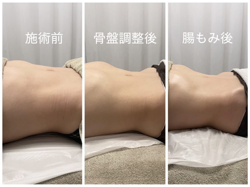 腸もみと骨盤調整後の効果