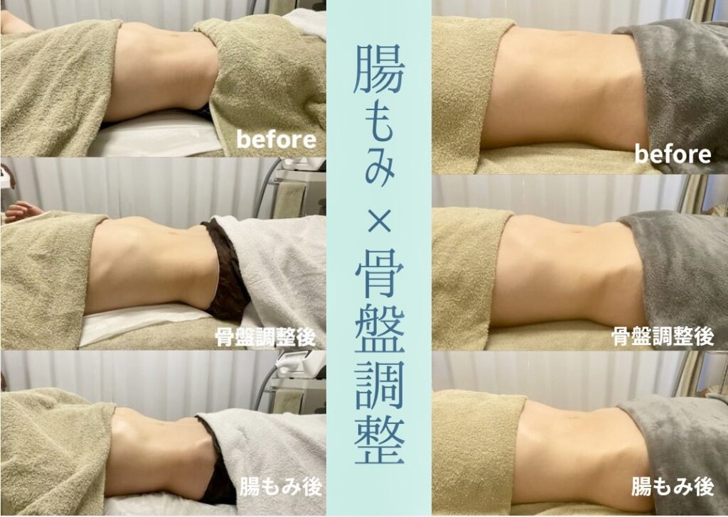 腸もみと骨盤調整